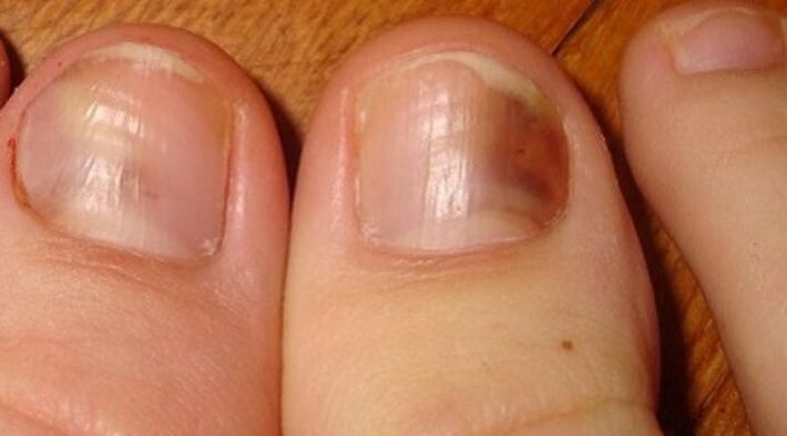 infecție fungică a unghiilor