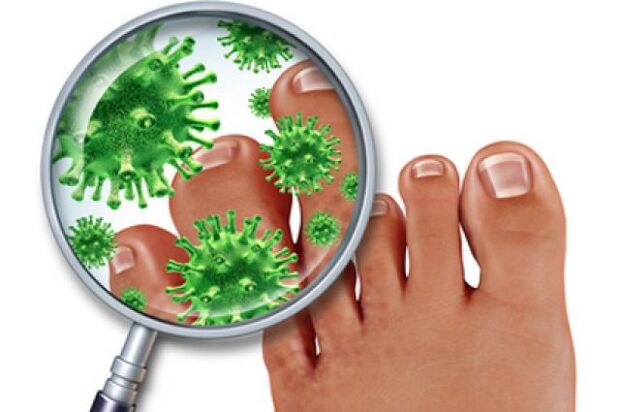 infecție fungică pe unghiile de la picioare