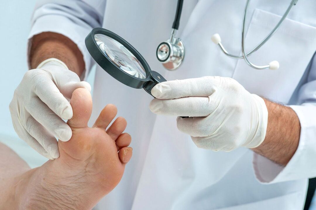 medicul examinează picioarele cu ciupercă