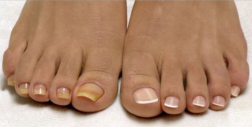 unghii sănătoase și ciuperci ale unghiilor de la picioare