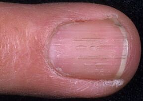 semne ale ciupercii unghiilor de la picioare