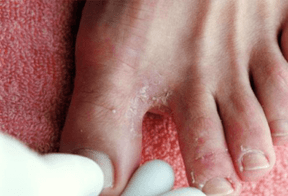simptome de ciuperca piciorului