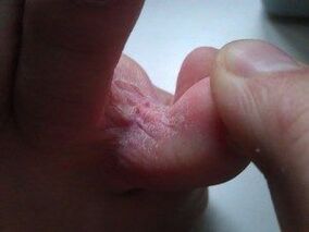 leziuni ale pielii între degetele de la picioare cu o ciupercă
