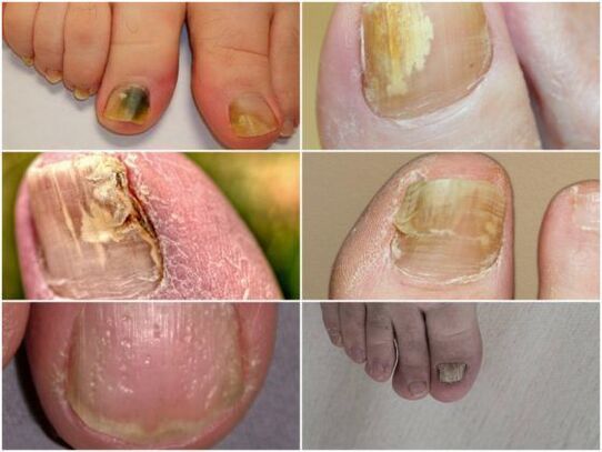 simptome ale infecției fungice a unghiilor