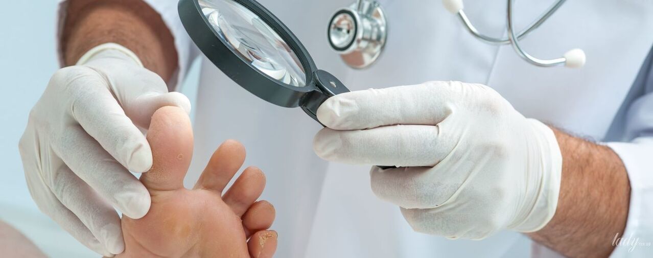 Doctorul examinează ciuperca de pe degetul de la picioare