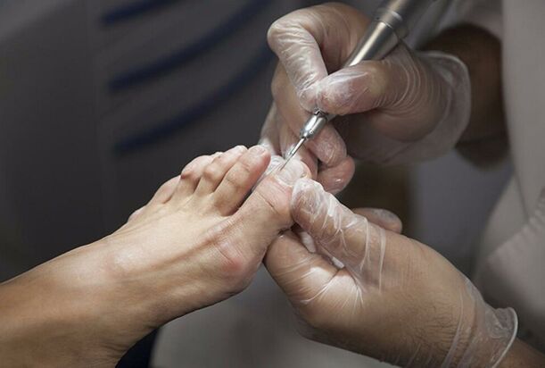 Diagnosticul ciupercii picioarelor