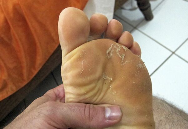 ciupercă pe pielea picioarelor