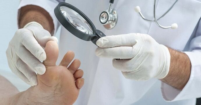 medicul examinează picioarele pentru ciuperca unghiilor