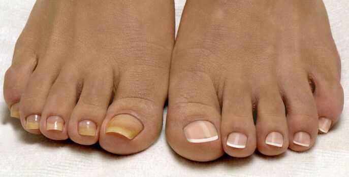 unghiile de la picioare și unghiile sănătoase afectate de ciuperci