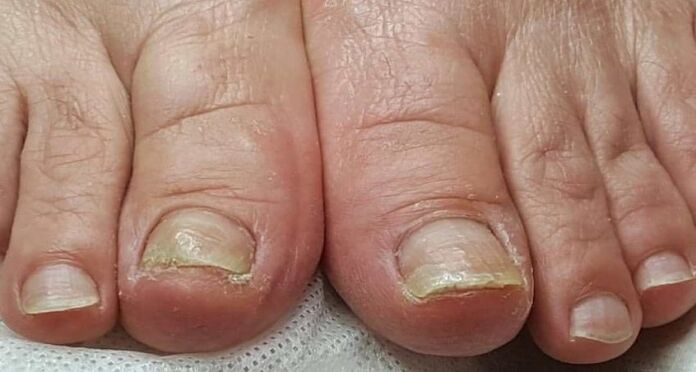 deteriorarea unghiilor cu ciuperca pe picioare
