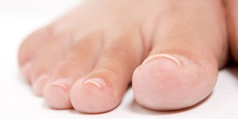 etapa inițială a ciupercii unghiilor de la picioare