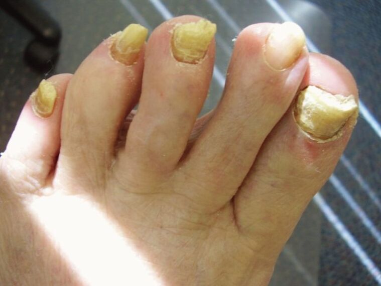 ciuperca neglijata a unghiilor de la picioare