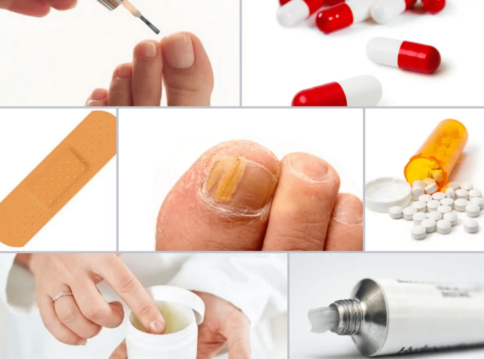 medicamente sistemice pentru ciuperca unghiilor de la picioare