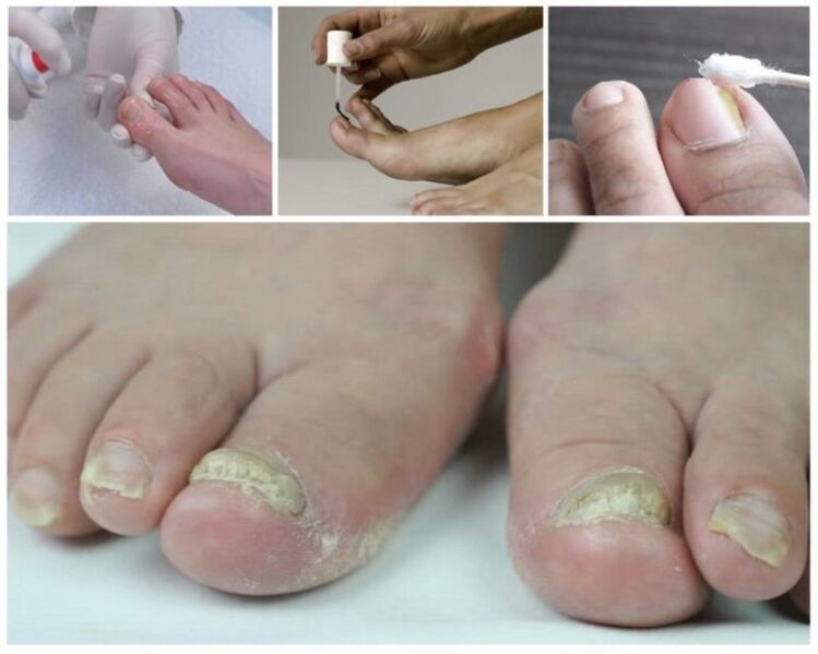 remedii pentru ciuperca unghiilor de la picioare