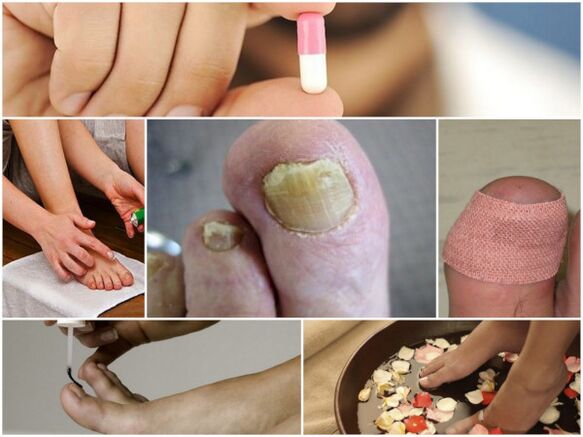 tipuri de remedii pentru ciuperca unghiilor de la picioare