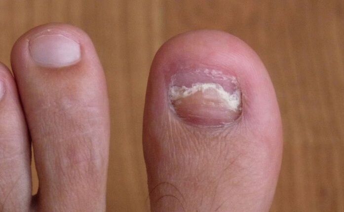 deteriorarea unghiei de pe degetul mare cu o ciupercă