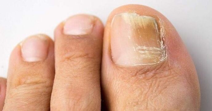 toenail galben cu infecție fungică