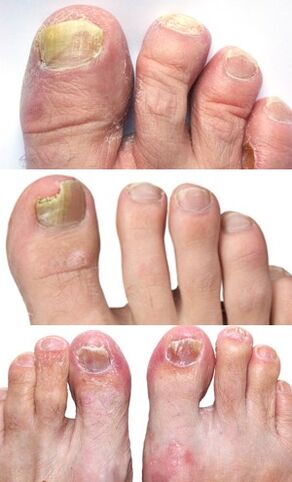 fotografia ciupercii unghiilor de la picioare