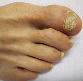 stadiul avansat al ciupercii unghiilor de la picioare