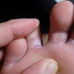 fisuri între degetele de la picioare simptome de ciuperci